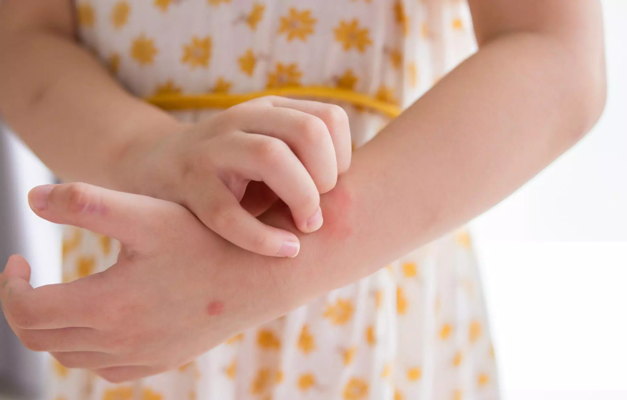 Homemade Mosquito Repellent Cleanzen Image of a Little Girl Scratching Insect Bites